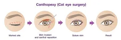 مزایای جراحی چشم گربهای (کانتوپلاستی)