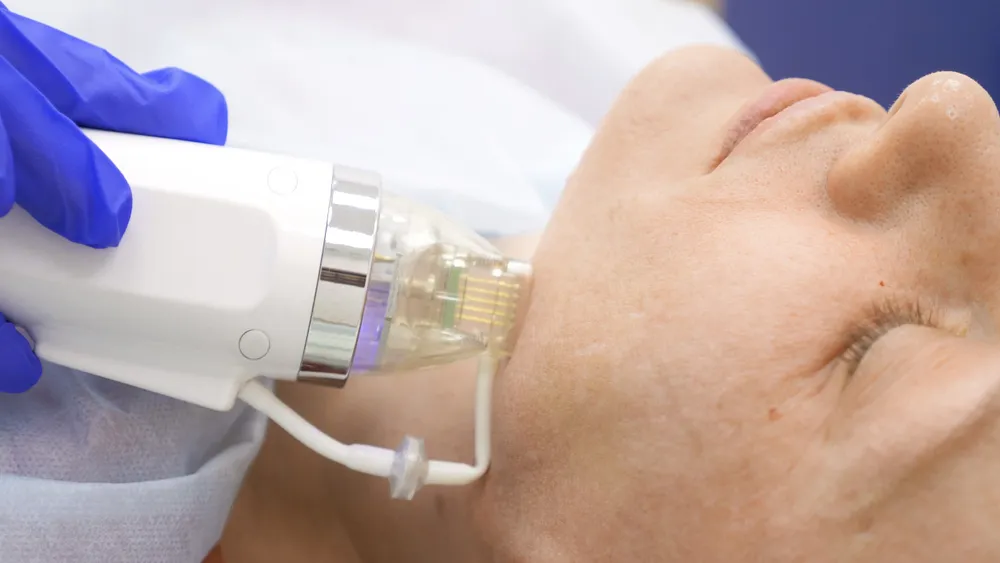 لیزر آر اف فرکشنال (Fractional RF): جوانسازی در عمق با تحریک تولید کلاژن 