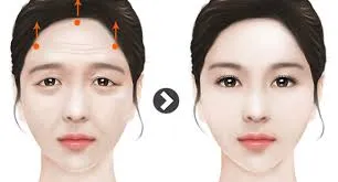 تأثیرات طبیعی لیفت شقیقه بر فرم صورت