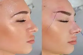 مراقبت‌های قبل از لیفت شقیقه با نخ