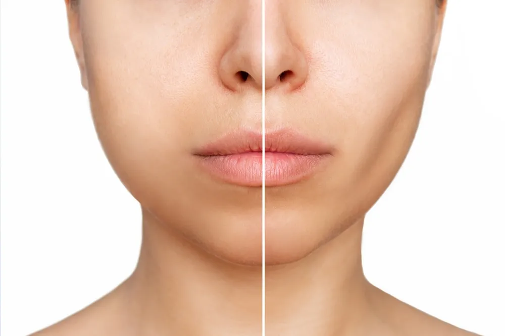 بوکال فت؛ حذف چربی گونه و ایجاد زاویه‌سازی چهره