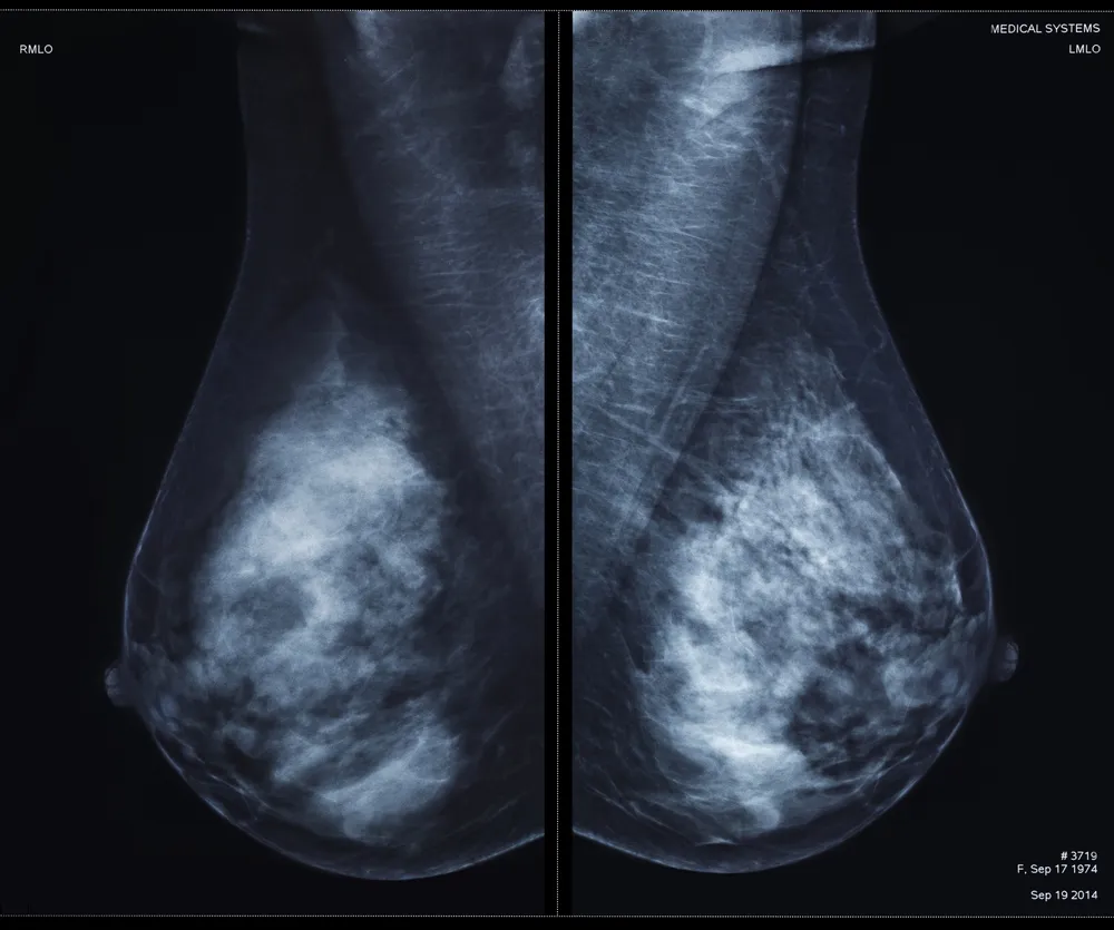 عوارض و خطرات ماموپلاستی در افراد با سابقه سرطان سینه