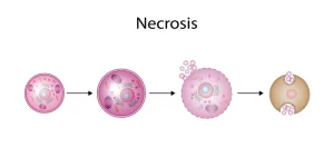 نکروز ماموپلاستی سینه: عارضه‌ای مهم در جراحی زیبایی سینه