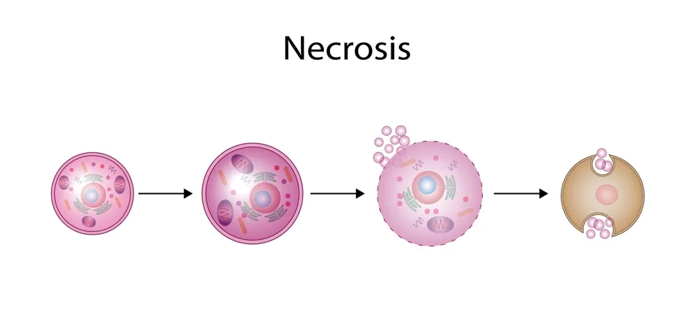 نکروز ماموپلاستی سینه: عارضه‌ای مهم در جراحی زیبایی سینه