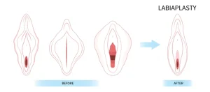 لابیاپلاستی: از زیبایی‌ و تناسب تا سلامت اندام تناسلی