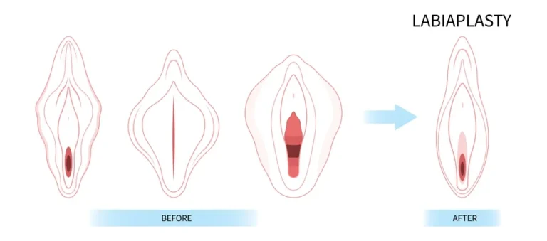لابیاپلاستی: از زیبایی و تناسب تا سلامت اندام تناسلی