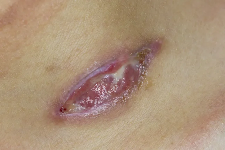 عفونت زخم ماموپلاستی و عوامل ایجاد آن