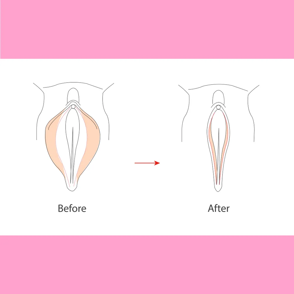 دوران نقاهت لابیاپلاستی و اصول مراقبت تخصصی پس از عمل