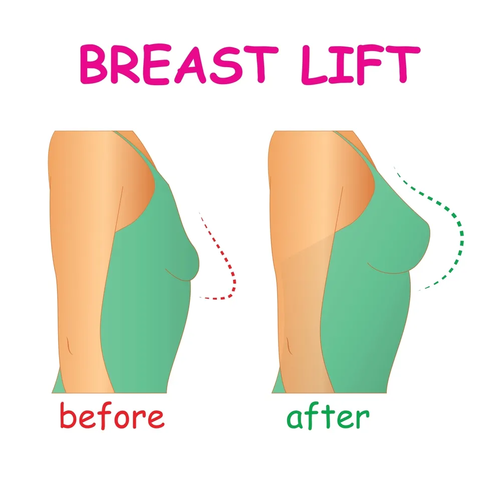لیفت سینه با جراحی