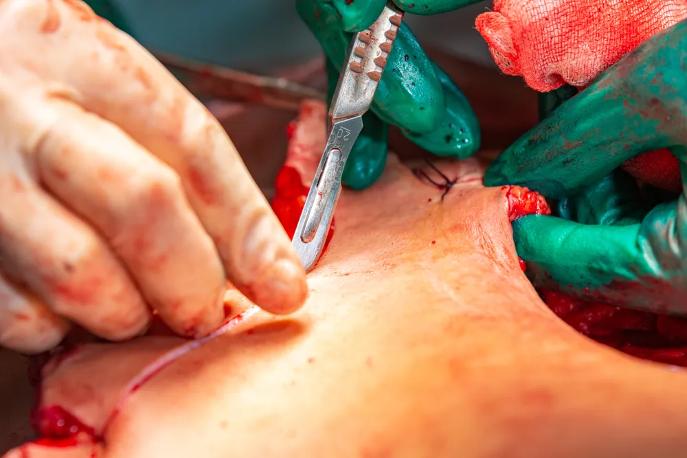 ریسکها و عوارض احتمالی ابدومینوپلاستی بعد از سزارین