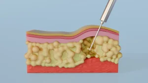 تفاوت ابدومینوپلاستی با پیکرتراشی