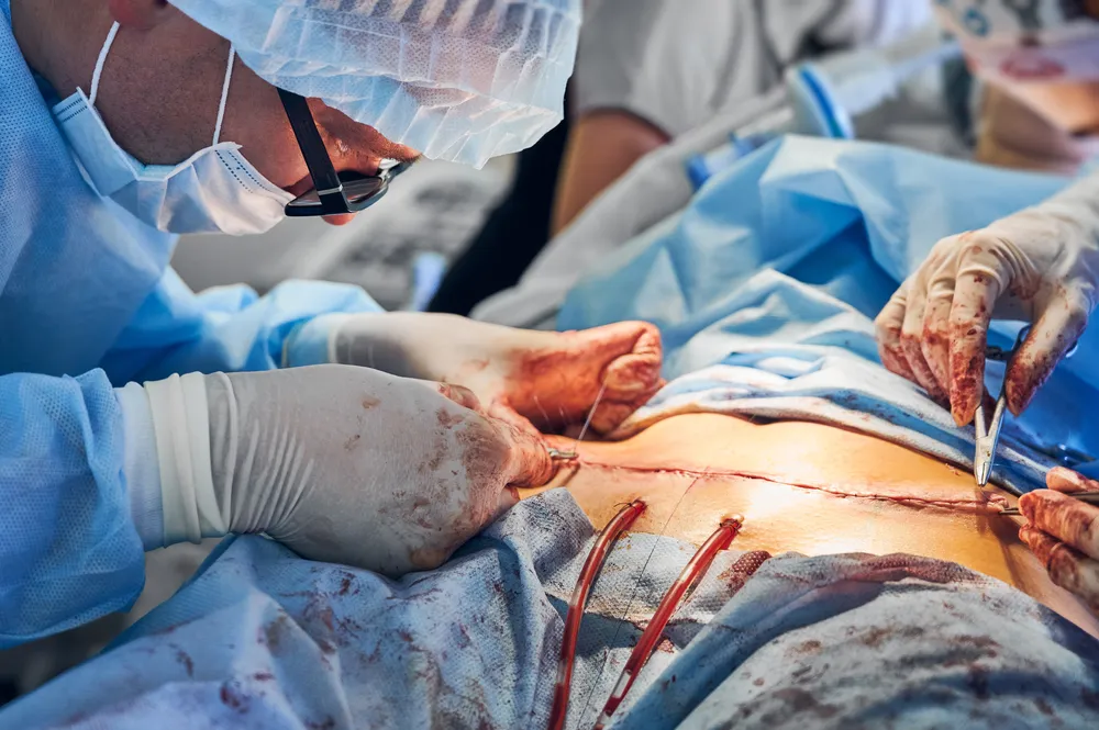 اقدامات پیش از جراحی برای رسیدن به بهترین نتیجه ابدومینوپلاستی