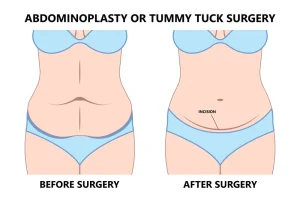 بهترین مرکز ابدومینوپلاستی در پاسداران (تهران)