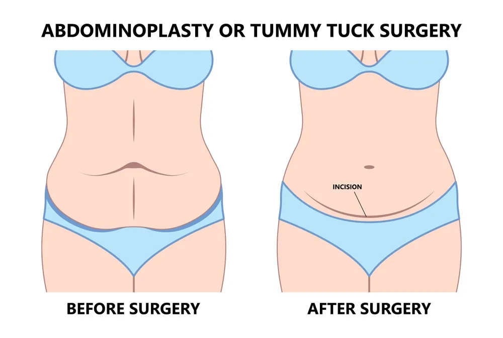 بهترین مرکز ابدومینوپلاستی در پاسداران (تهران)